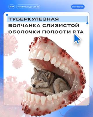 Люпома: симптом «яблочного желе» в практике стоматолога.